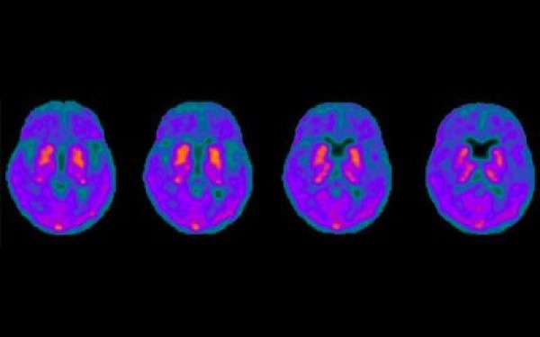 PET imaging key to understanding Parkinson's disease dementia