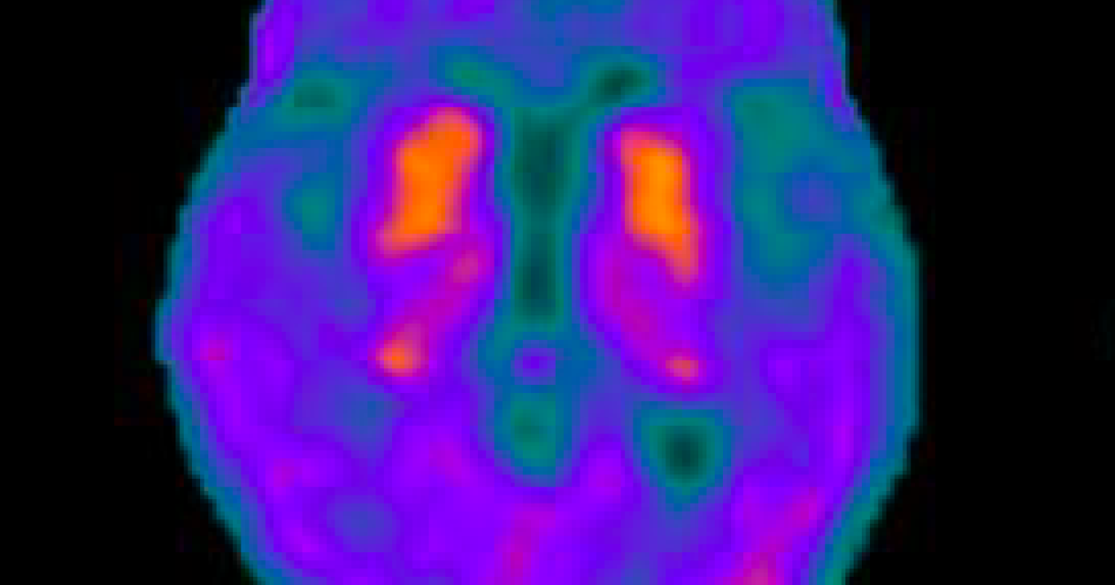 Neurodegenerative research