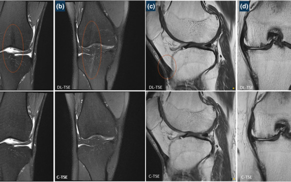Deep-Learning TSE imaging can provide enhanced knee images